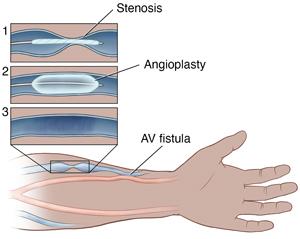 Fistulogram and Angioplasty for Your AV Fistula